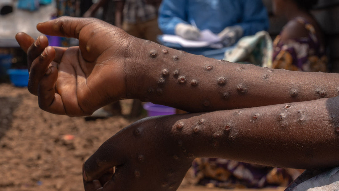 What to know about Mpox